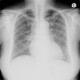 Influenza, second x-ray: X-ray - Plain radiograph